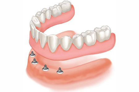 Зубное протезирование -